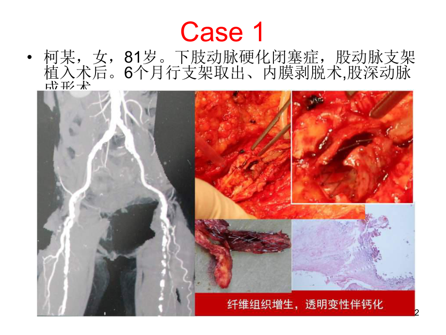 支架内再狭窄的治疗进展参考课件.ppt_第2页