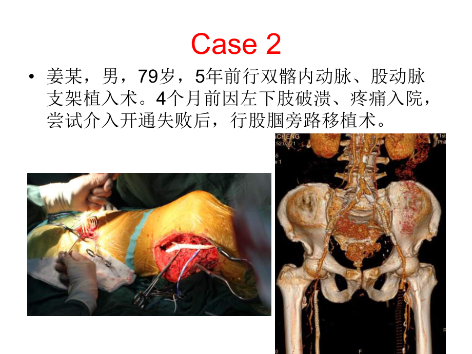 支架内再狭窄的治疗进展参考课件.ppt_第3页