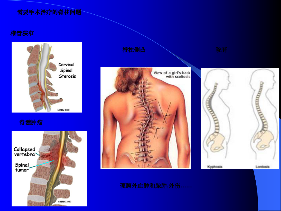 手术室护理查房脊柱手术的麻醉课件-2.ppt_第3页