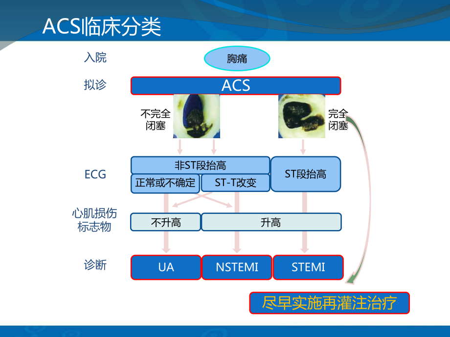 急性心肌梗死汇总讲义课件.ppt_第3页