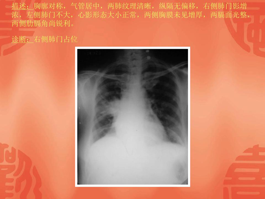 常见40张X片读片及诊断课件.ppt_第2页