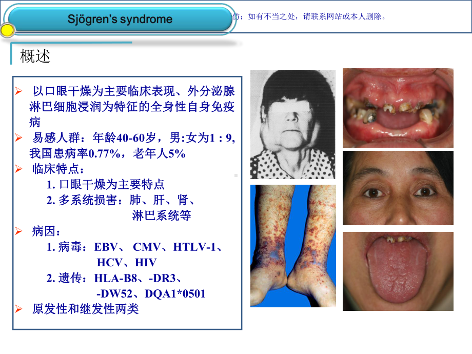 干燥综合征汇总课件.ppt_第2页