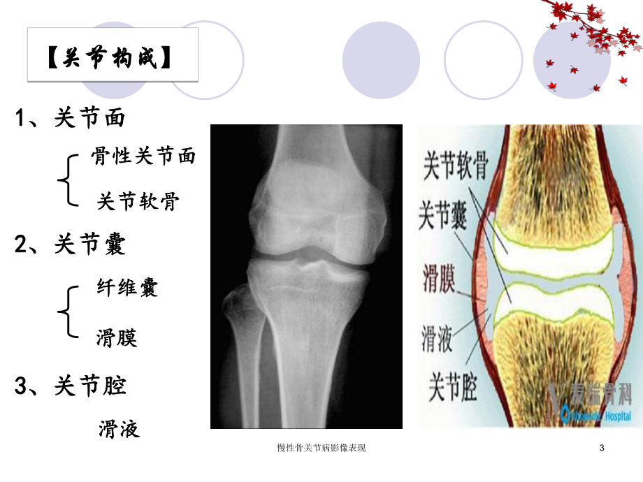 慢性骨关节病影像表现课件.ppt_第3页