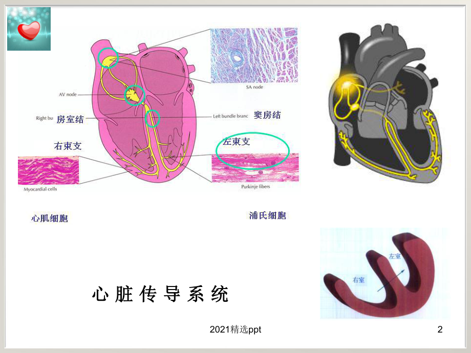 左束支传导阻滞与急性心肌梗死课件.ppt_第2页