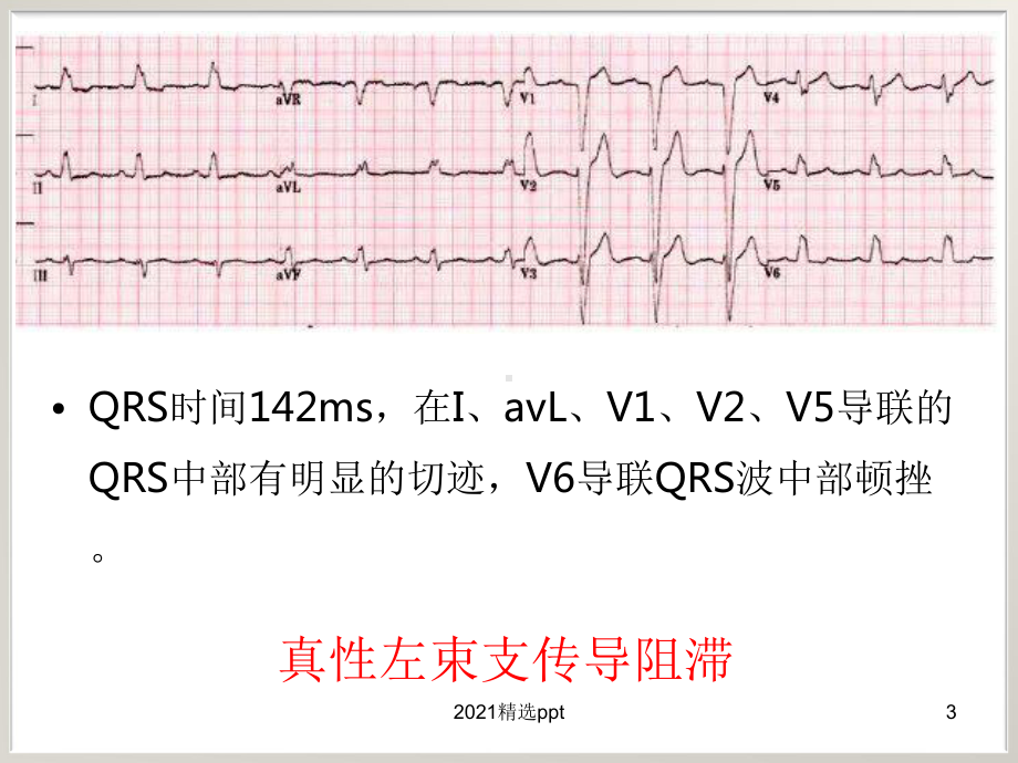 左束支传导阻滞与急性心肌梗死课件.ppt_第3页