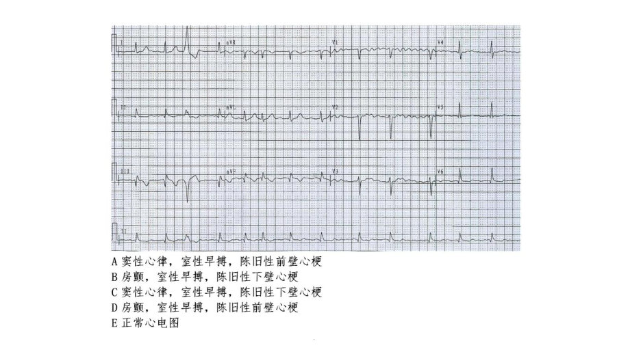 心电图练习题(带图有答案)课件.ppt_第3页