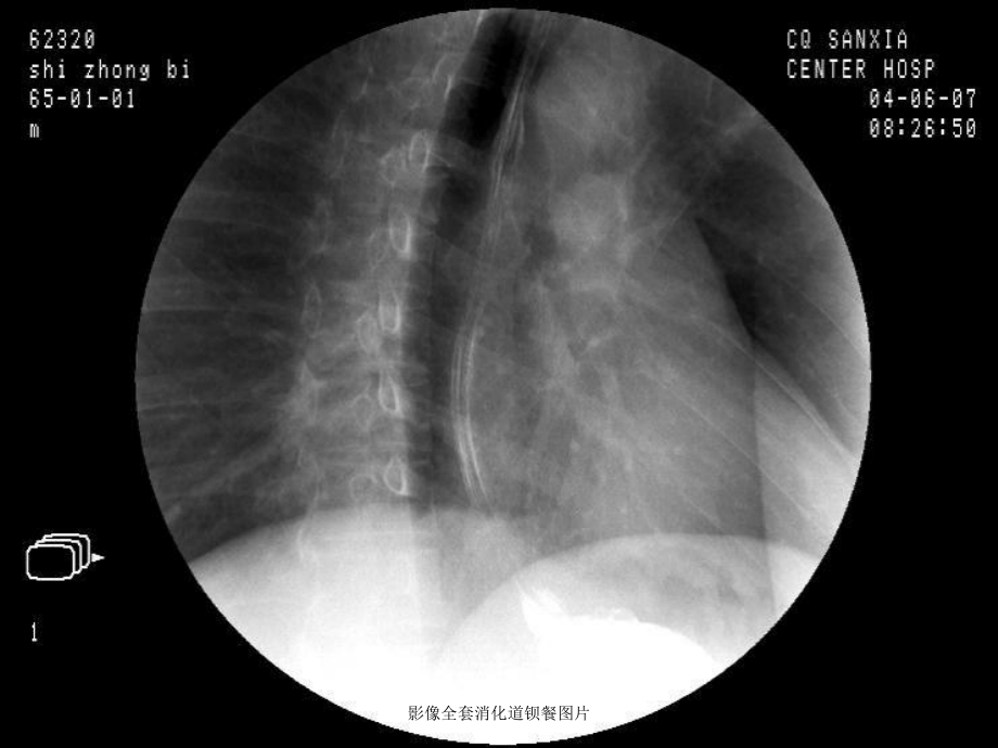 影像全套消化道钡餐图片培训课件.ppt_第3页