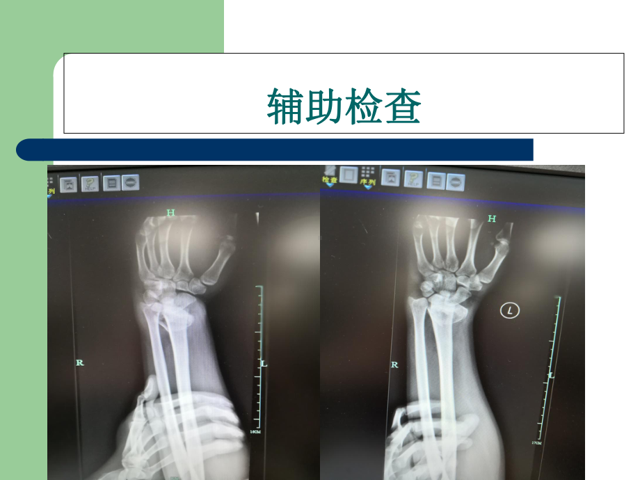 桡骨远端骨折教学查房主题讲座课件.ppt_第3页