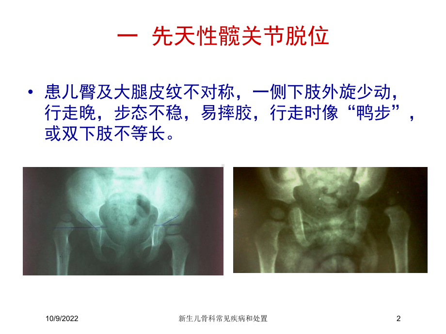 新生儿骨科常见疾病和处置培训课件.ppt_第2页