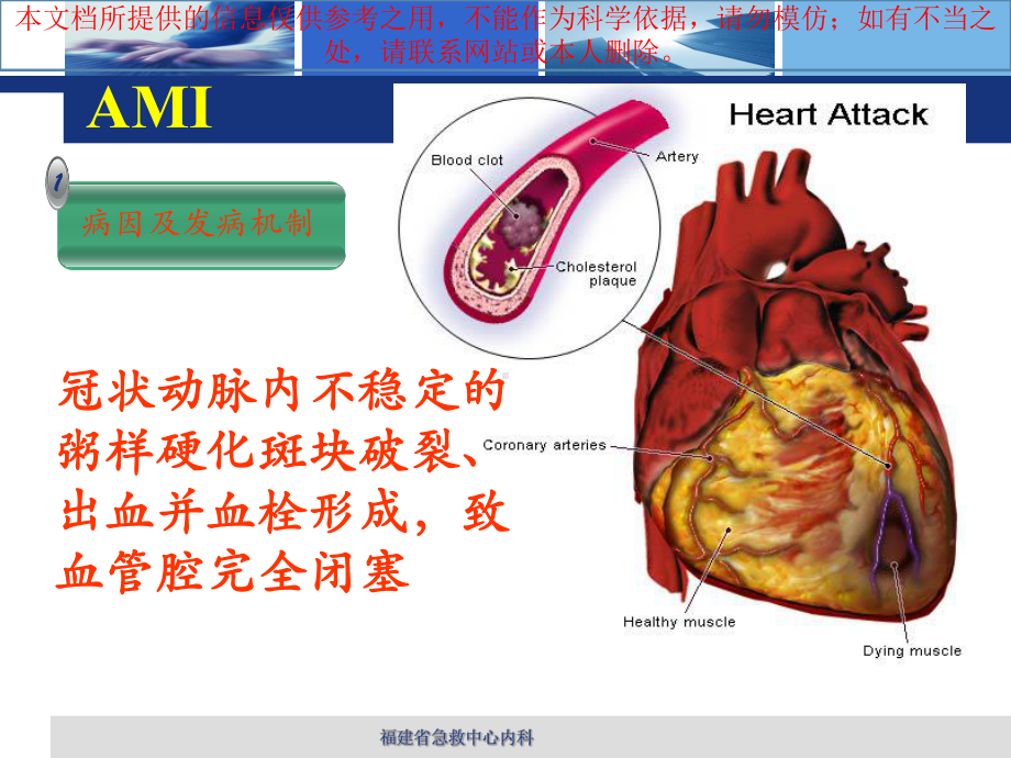 急性心肌梗死培训课件.ppt_第2页