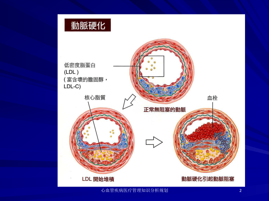 心血管疾病医疗管理知识分析规划培训课件.ppt_第2页