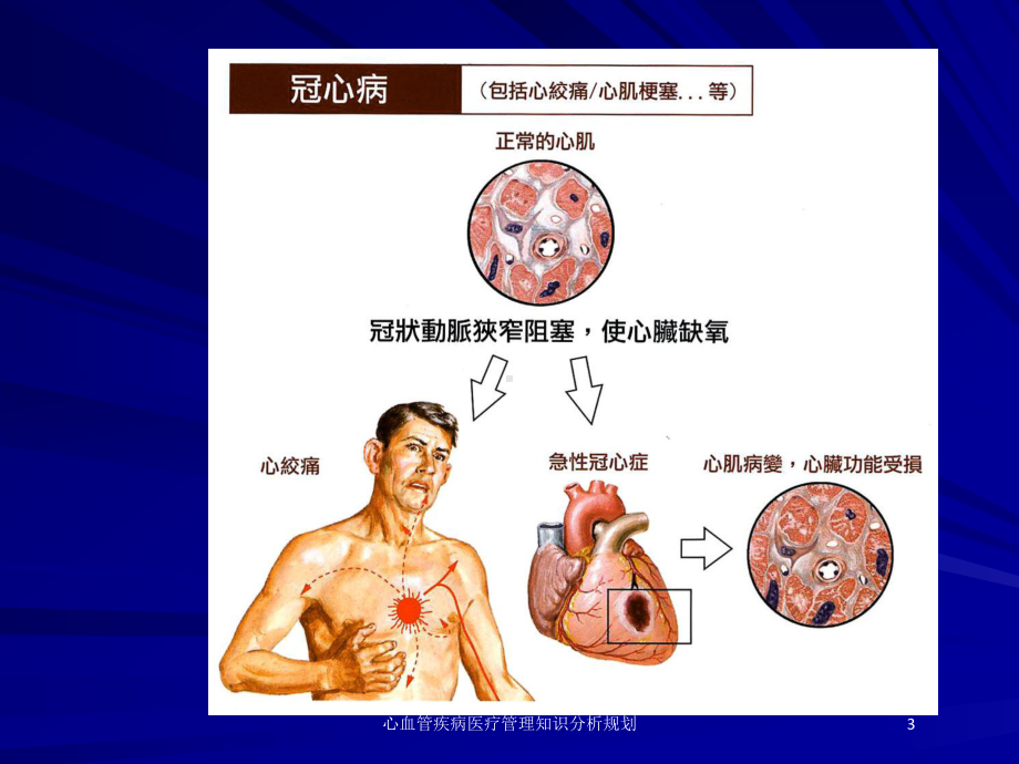 心血管疾病医疗管理知识分析规划培训课件.ppt_第3页