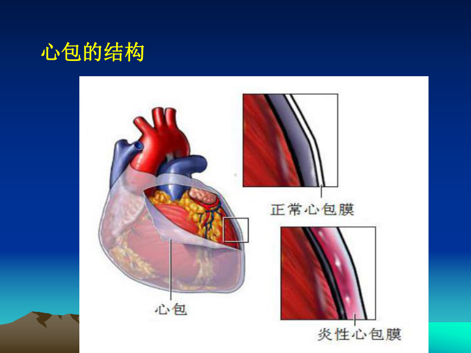 心包炎专题知识讲座培训课件.ppt_第3页