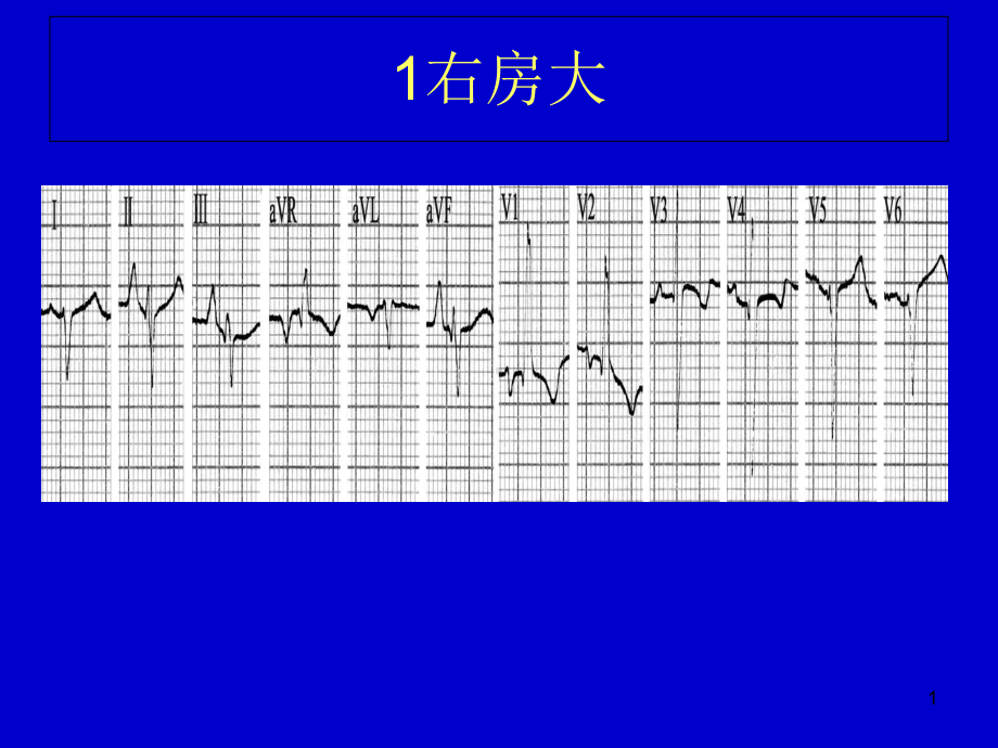 心电图典型图谱学习课件.ppt_第1页