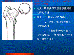 影像学股骨颈骨折培训课件.ppt