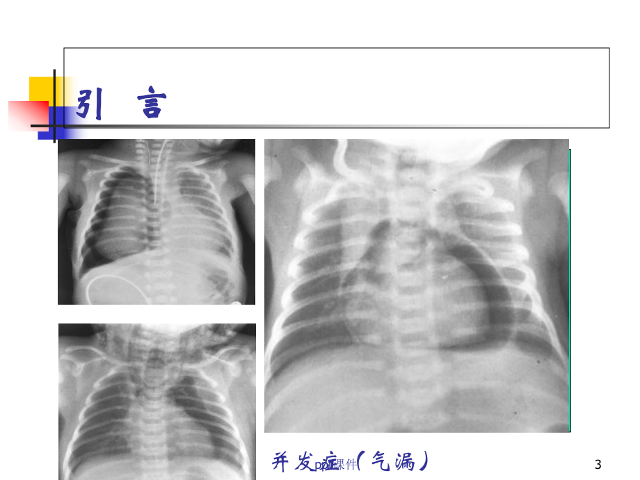 新生儿机械通气和安全氧疗-课件.ppt_第3页