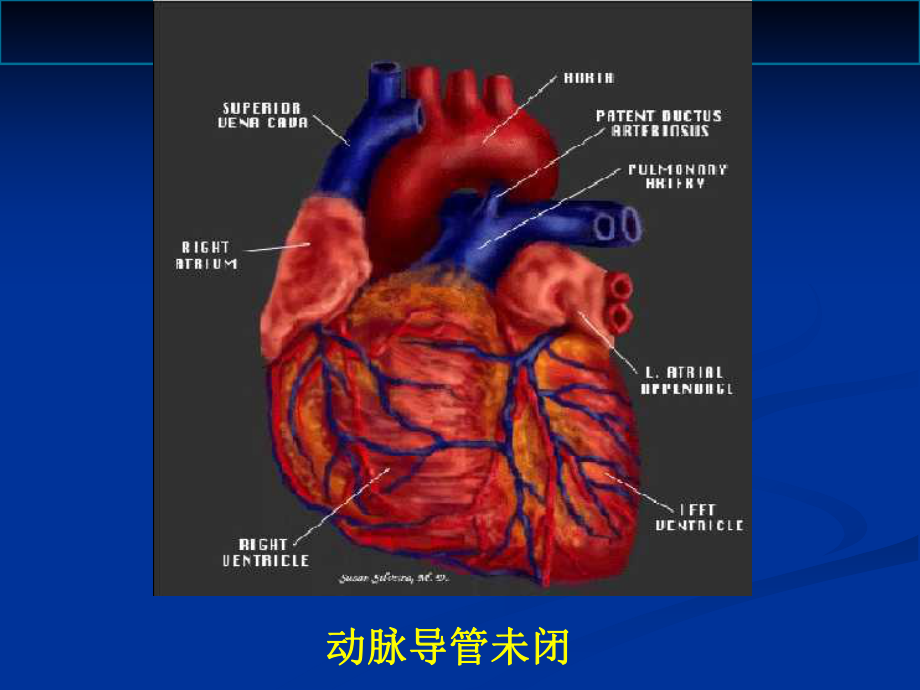 早产儿动脉导管开放课件.ppt_第1页