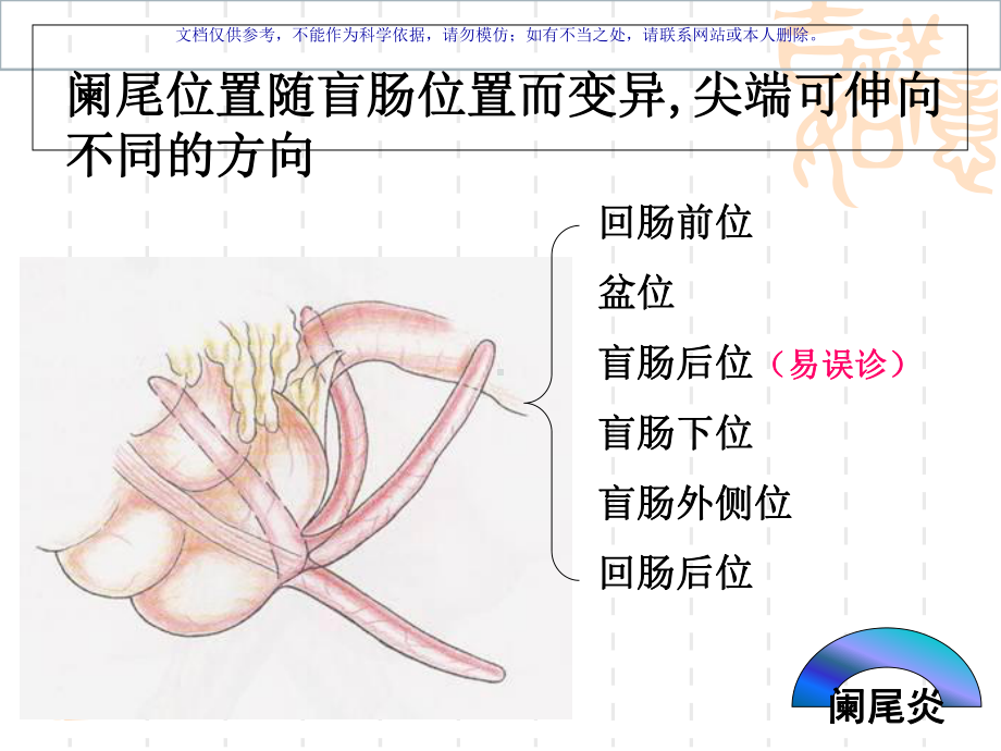 急性阑尾炎专业知识课件.ppt_第2页