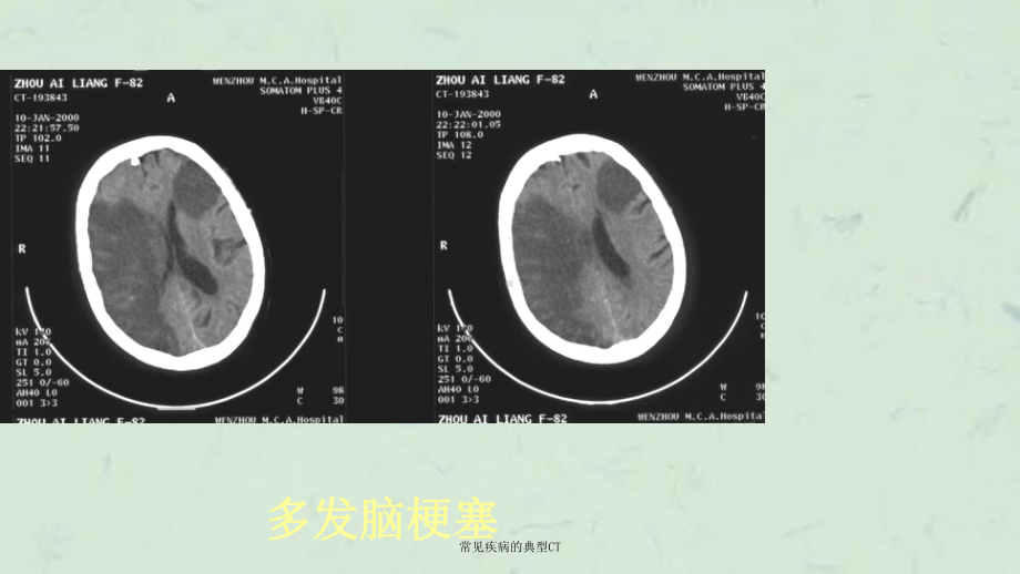 常见疾病的典型CT课件.ppt_第2页