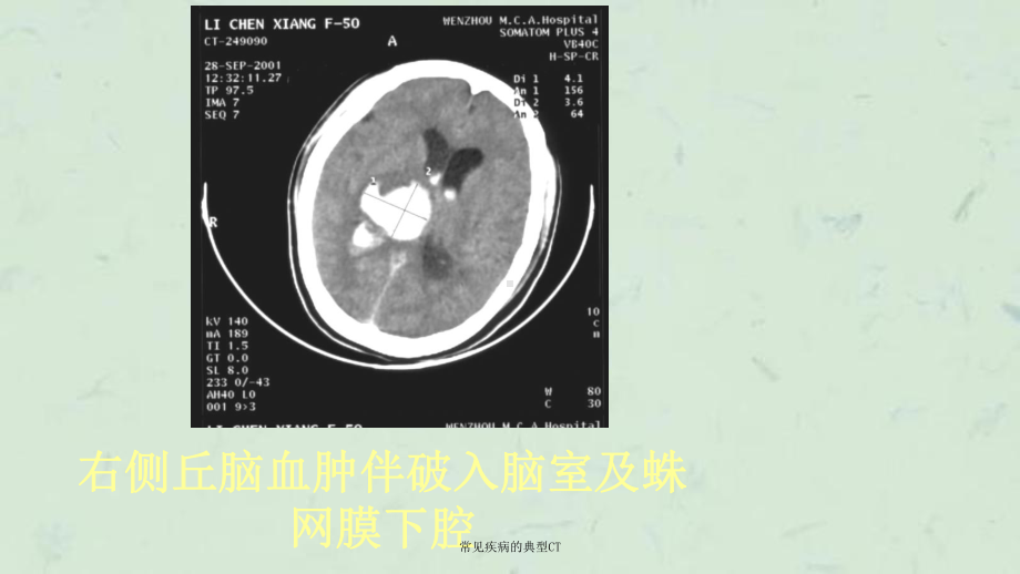 常见疾病的典型CT课件.ppt_第3页