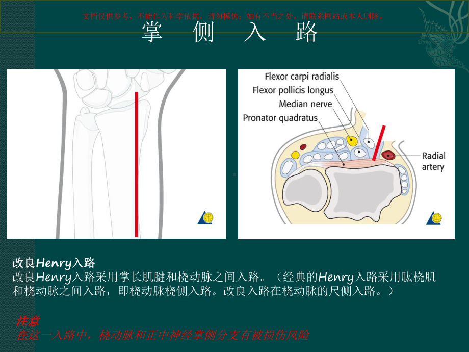 桡骨远端骨折培训课件.ppt_第3页