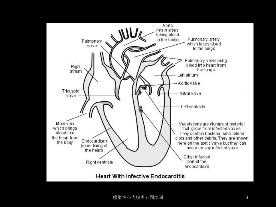 感染性心内膜炎专题培训培训课件.ppt_第3页