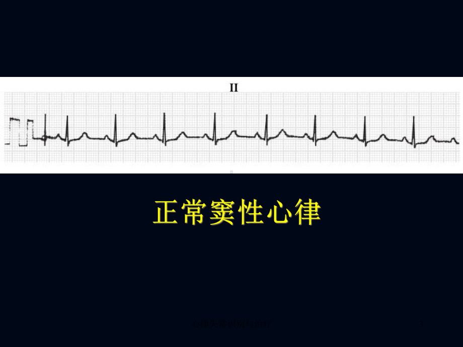 心律失常识别与治疗课件.ppt_第3页