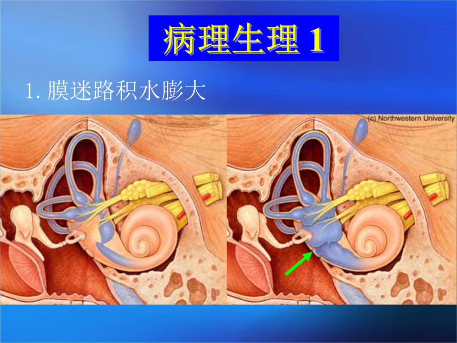 梅尼埃病(七年制)课件.ppt_第3页