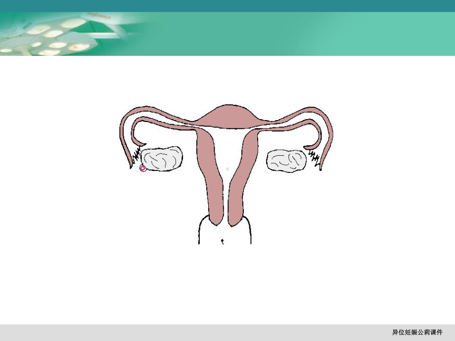 异位妊娠公莉课件.ppt_第3页