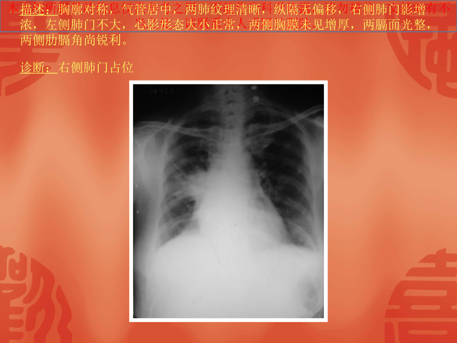 常见四十张X片读片及诊断培训课件.ppt_第1页