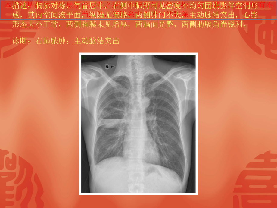 常见四十张X片读片及诊断培训课件.ppt_第3页