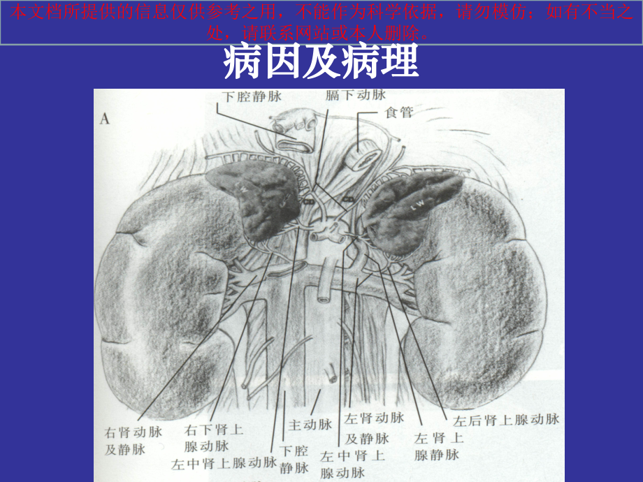 左肾静脉受压综合征培训课件.ppt_第2页