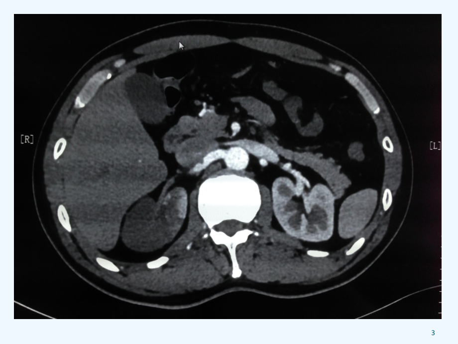急性肾梗死的诊断与治疗课件.ppt_第3页