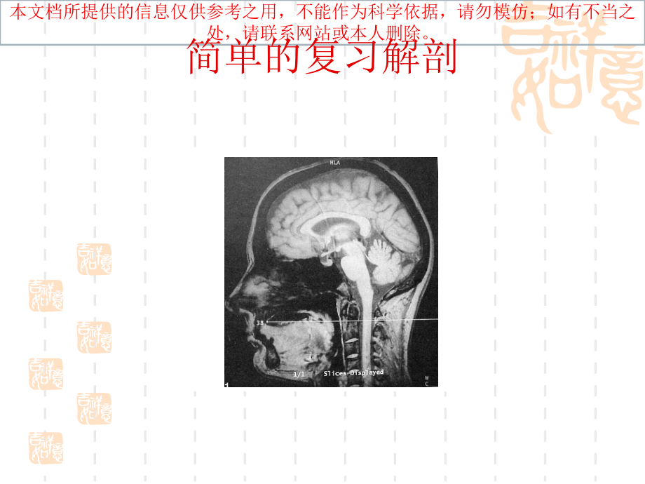 延髓背外侧综合征宣讲培训课件.ppt_第1页