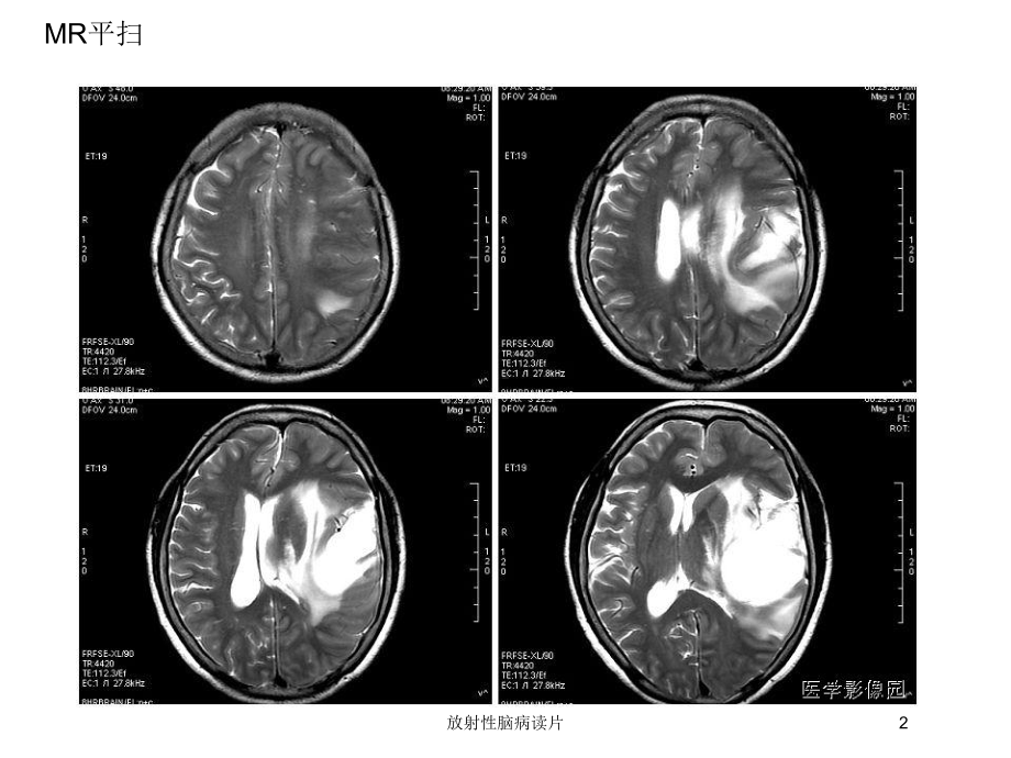 放射性脑病读片培训课件.ppt_第2页