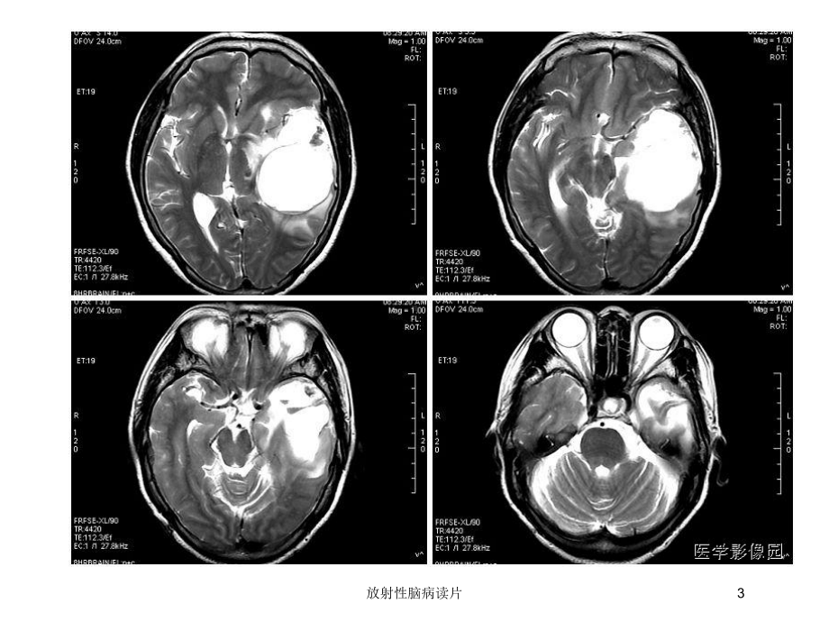 放射性脑病读片培训课件.ppt_第3页