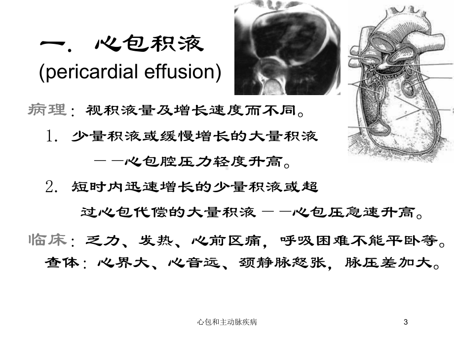 心包和主动脉疾病培训课件.ppt_第3页