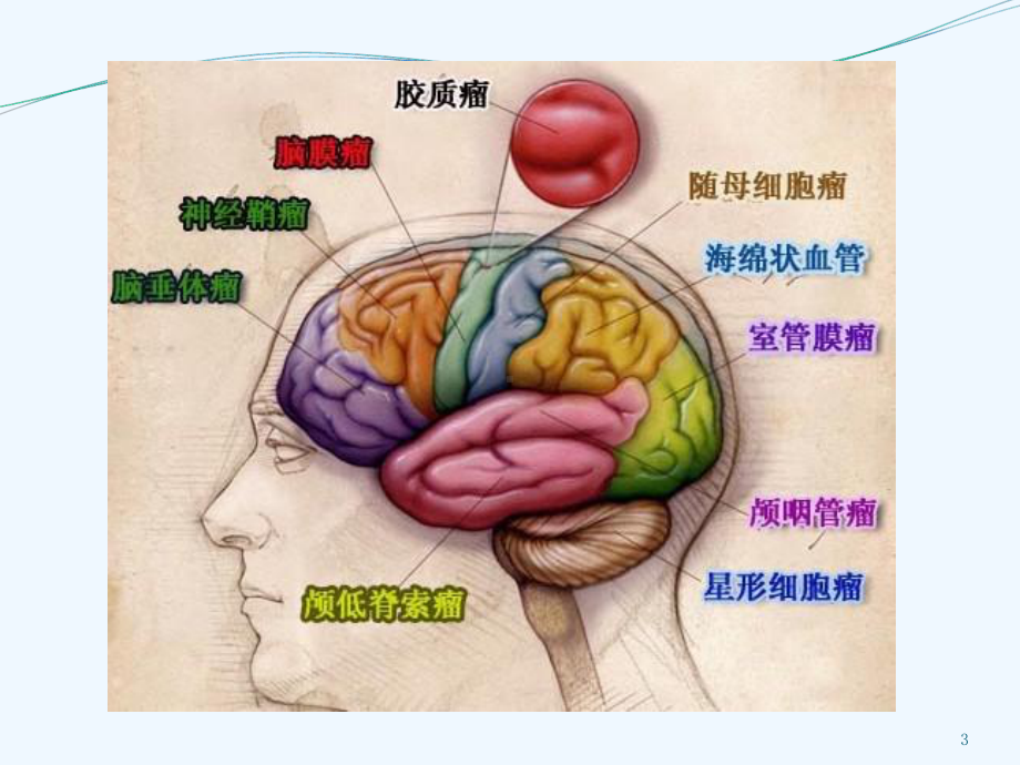 常见脑肿瘤的影像诊断课件.ppt_第3页