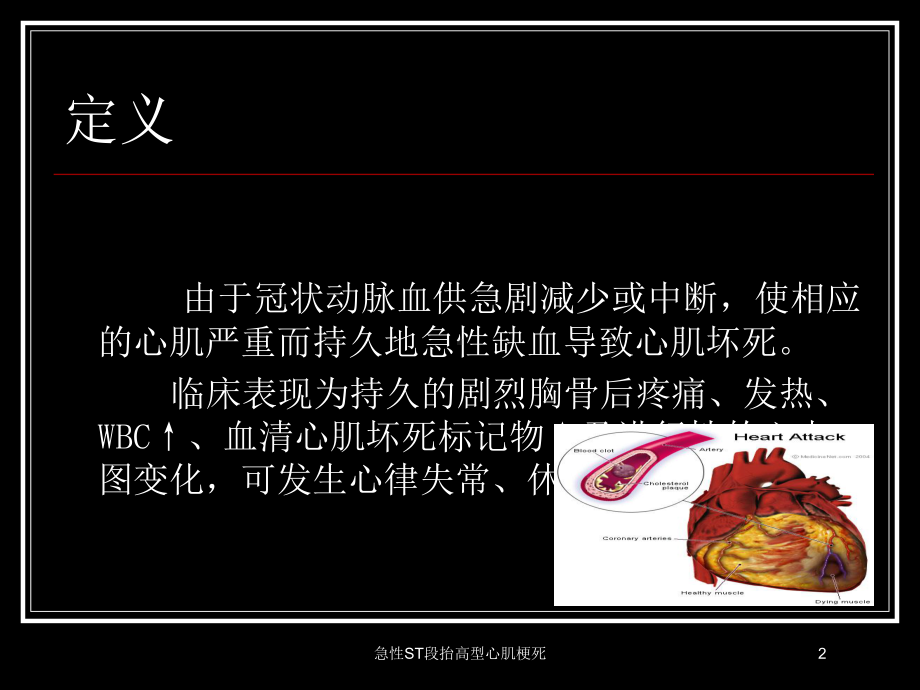 急性ST段抬高型心肌梗死培训课件.ppt_第2页