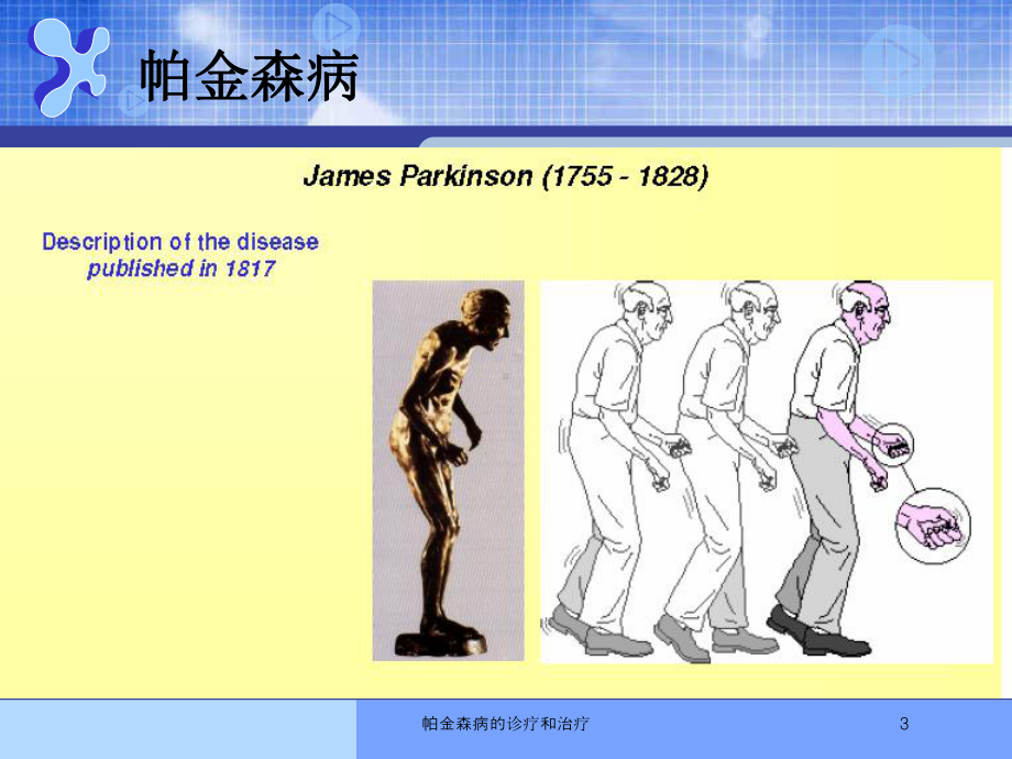 帕金森病的诊疗和治疗培训课件.ppt_第3页