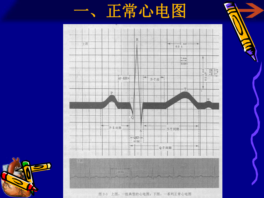 心动过速鉴别诊断课件.ppt_第2页