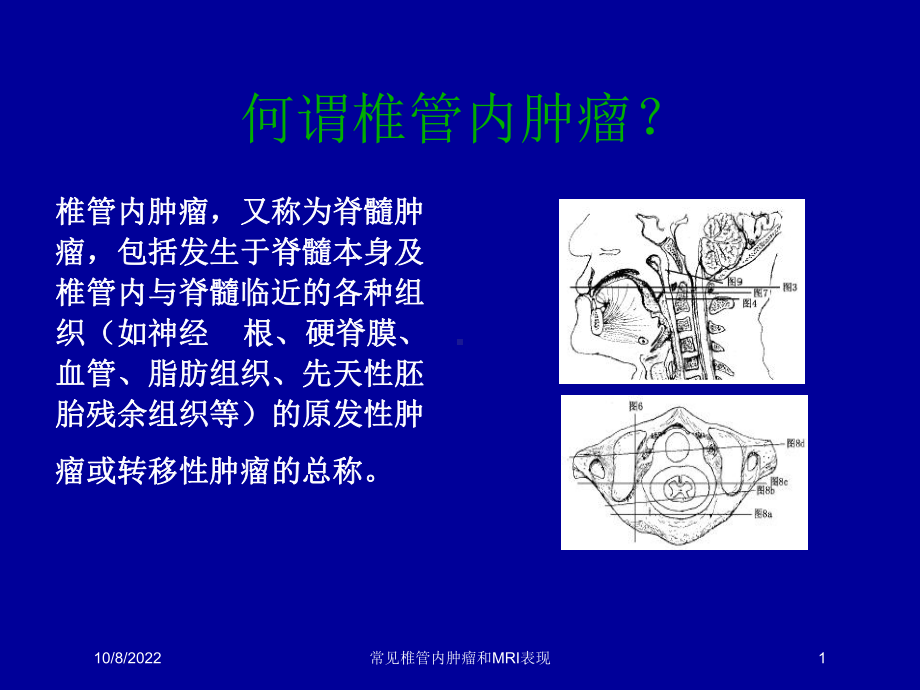 常见椎管内肿瘤和MRI表现课件.ppt_第1页