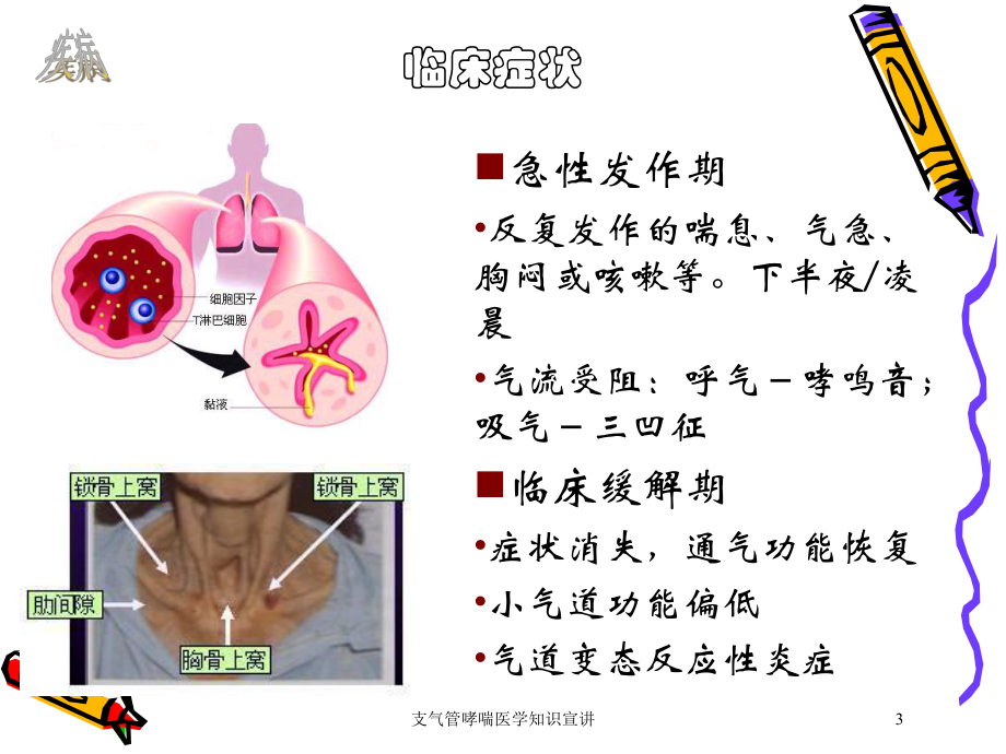 支气管哮喘医学知识宣讲培训课件.ppt_第3页