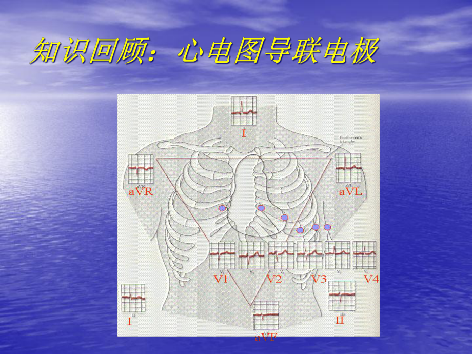 常见心脏疾病心电图诊断课件.ppt_第3页