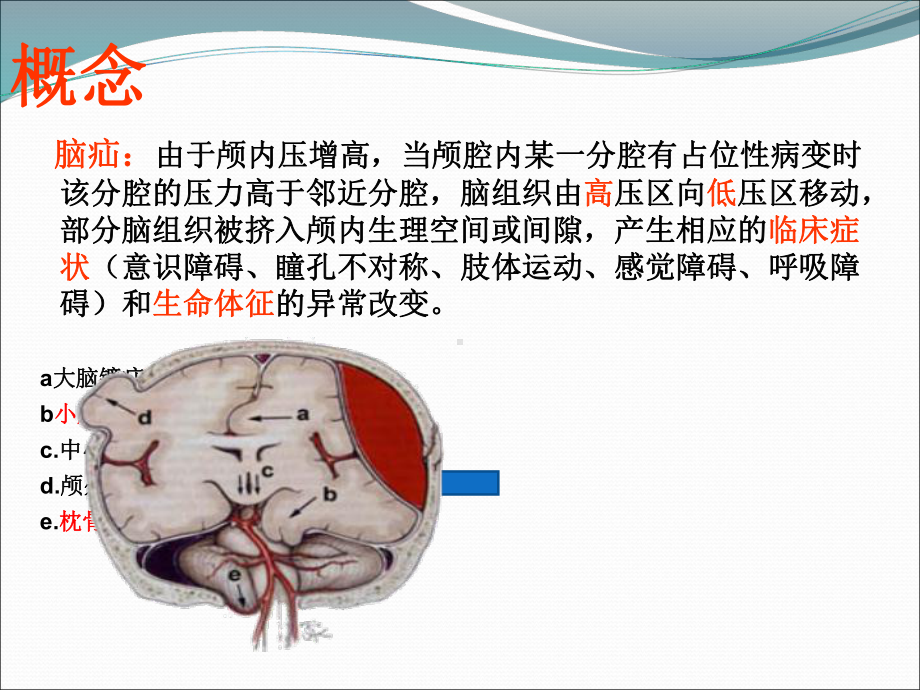 急性脑疝的护理-课件.ppt_第2页