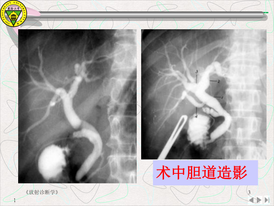 梗阻性黄疸的影像学诊断课件-2.ppt_第3页