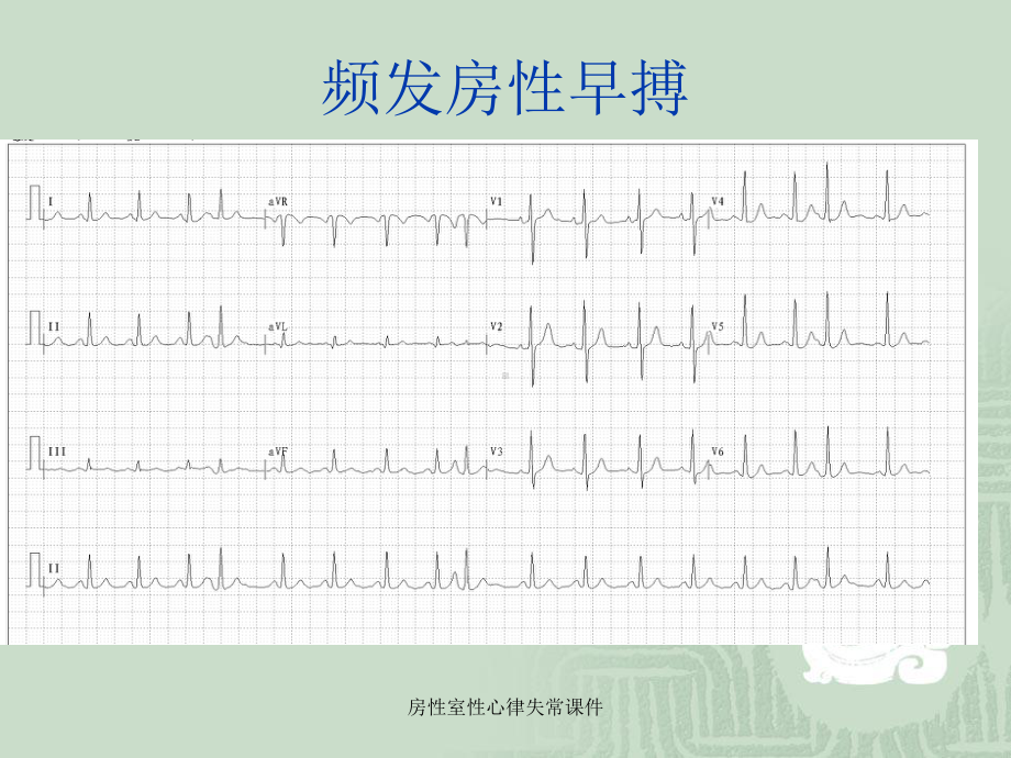 房性室性心律失常课件.ppt_第3页