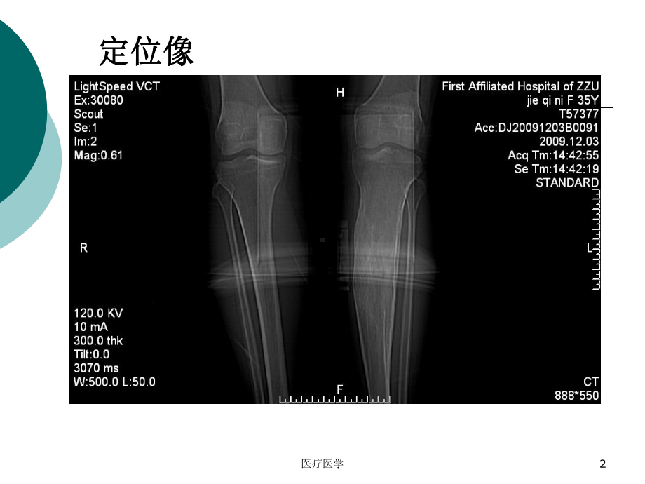 慢性骨髓炎(行业运用)课件.ppt_第2页