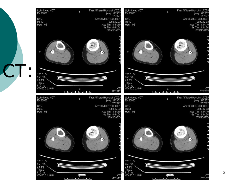 慢性骨髓炎(行业运用)课件.ppt_第3页