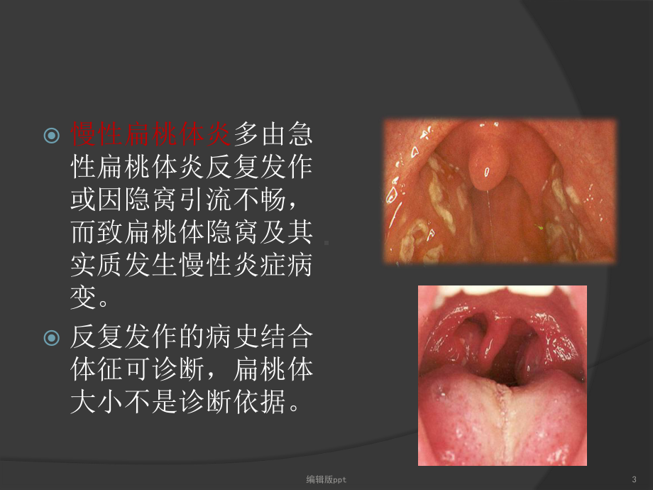 扁桃体切除对IgA肾病的影响课件.ppt_第3页